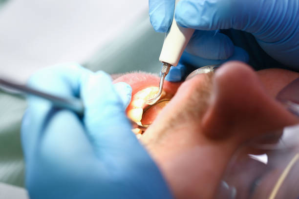 Best Emergency Wisdom Teeth Removal in Laverne, OK