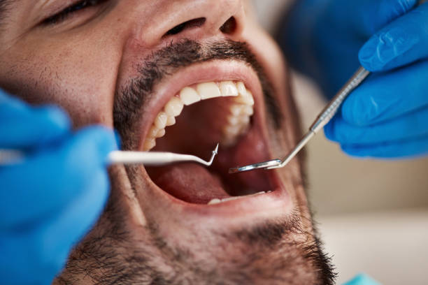 Best Emergency Wisdom Teeth Removal in Laverne, OK