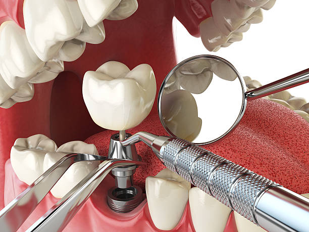 Best Emergency Tooth Extraction in Laverne, OK